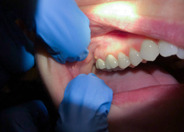 Best Emergency Tooth Extraction in Granite Hills, CA